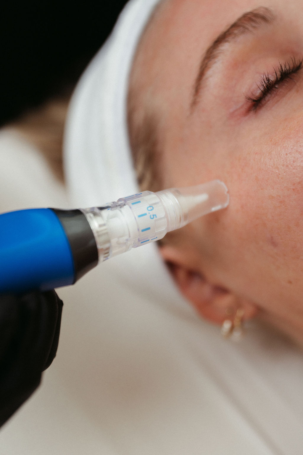 Microneedling treatment session
